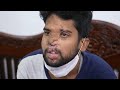 Fire Accident: Man who lost his face | Surgery Consultation