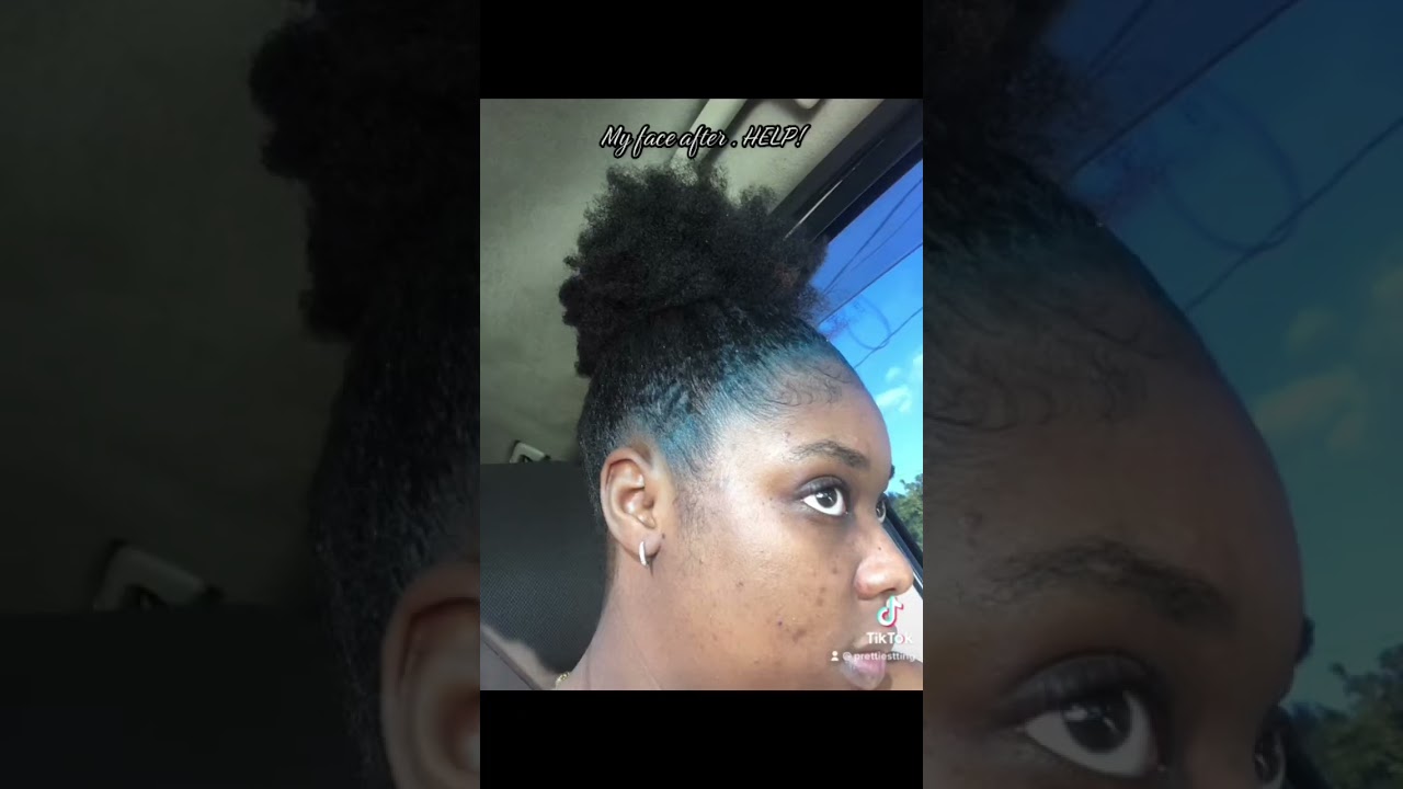 Did The Ordinary Vitamin C Suspension 23%+Spheres BREAK you out too or is it just me 😢?