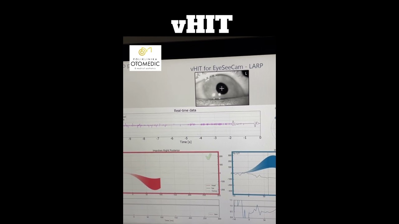 VIDEO HEAD IMPULSE TEST - vHIT 