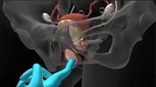 Ejercicios de Kegel - Visualización anatómica en 3D
