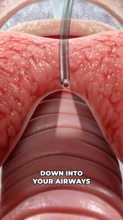 Bronchoscopy (3D Animation)