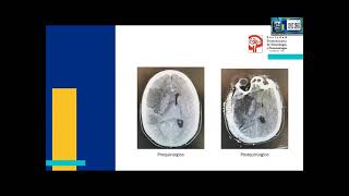 Dr. Alex Cueto (Rep  Dom) RESULTADOS DE LA CRANIECTOMIA DESCOMPRESIVA EN EL ACCIDENTE VASCULAR...