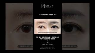 앞트임복원 무보정 사례모음 .zip #시선성형외과 #shorts