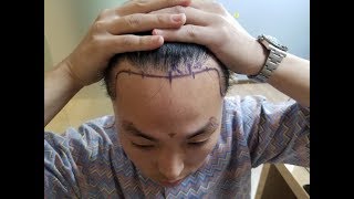 Hairliciously 2Nd Fue Hair Transplant