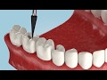 Какие есть виды протезирования зубов?