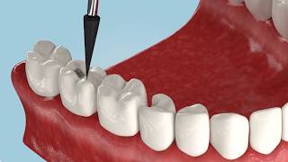 Какие есть виды протезирования зубов?