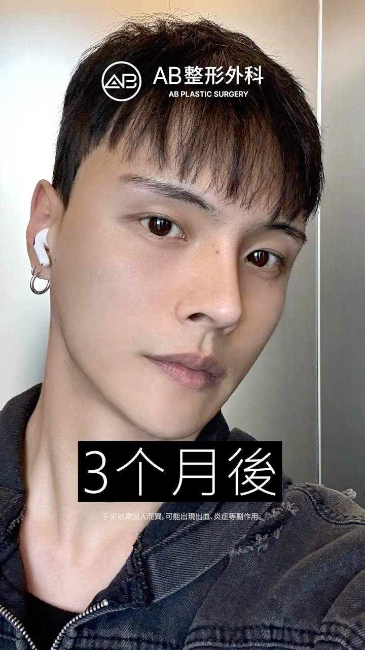轮廓三件套＋眼部整形＋鼻整形，改變了他的人生✨ #Shorts