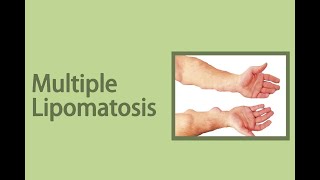 मल्टीपल लिपोमेटोसिस और इसका उपचार | Multiple Lipomatosis