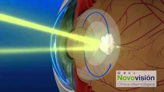 Los limpiar intraoculares lentes laser ojos para en