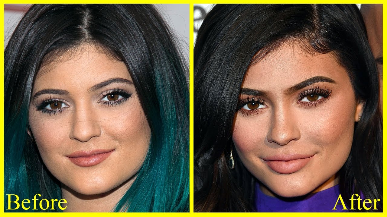 Kylie Jenner Before & After Plastic Surgery! + (Leaked ...