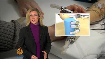 Bionic arm enables amputees to feel again