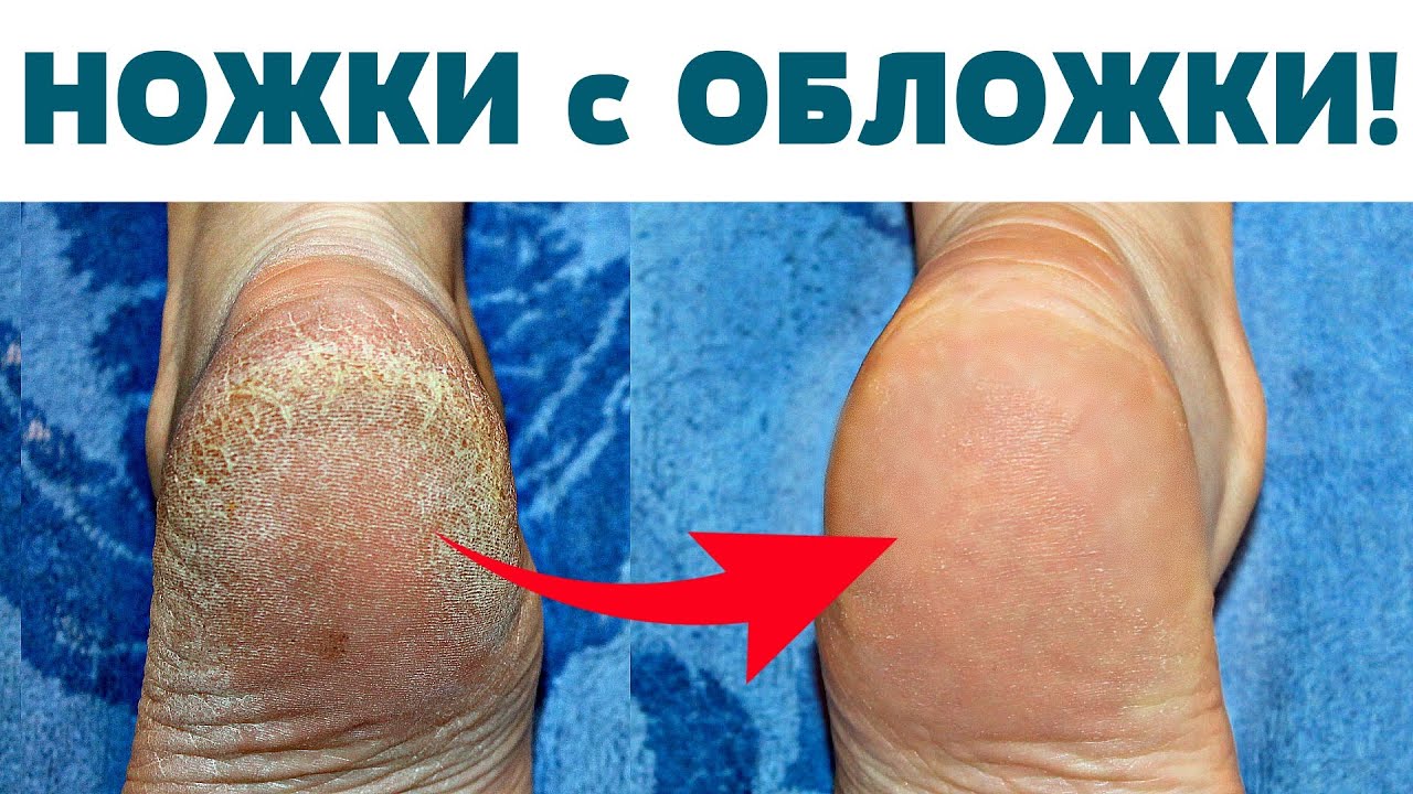 ИДЕАЛЬНЫЕ ПЯТКИ КАК У МЛАДЕНЦА Волшебное средство В ЛЮБОЙ АПТЕКЕ! СТОП ...