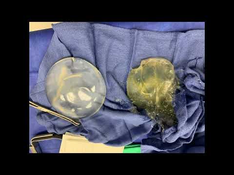 Corrective Breast Implant Surgery Using Motiva Implants