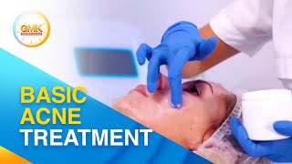 Simple acne treatment tips | Usapang Pangkalusugan