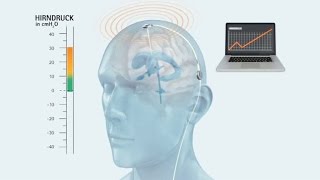 Normaldruckhydrozephalus MIETHKE Shunts