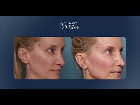Video thumbnail: Nano Smooth™ for the Eyes | Dr. Louis P. Bucky · Bucky Plastic Surgery