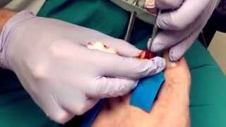 Surgical removal of deformed toenail