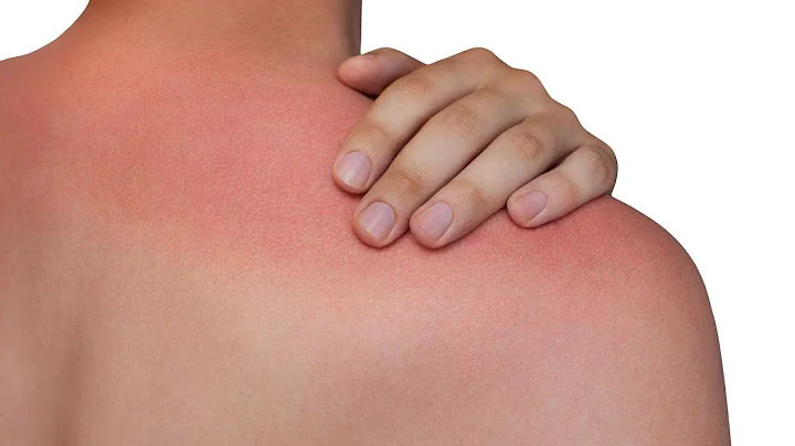 How To Treat and Prevent Heat Rash | Rachael's Der...