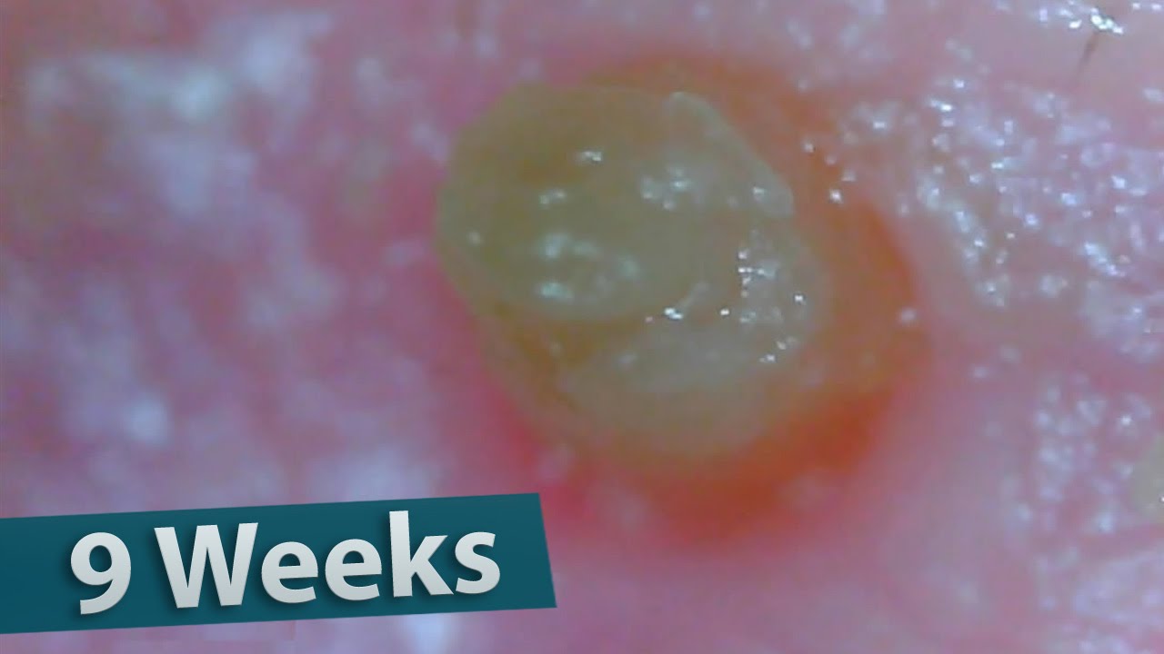 🐬5 Big Blackhead Removal (After 9 weeks) YouTube