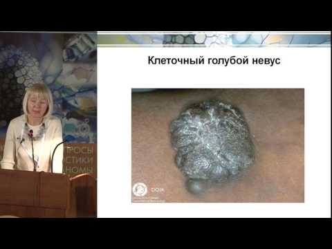 М.А. Гуреева, Доброкачественные меланоцитарные новообразования кожи.