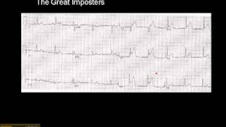 12-15 Lead ECG: MI Imposter 1