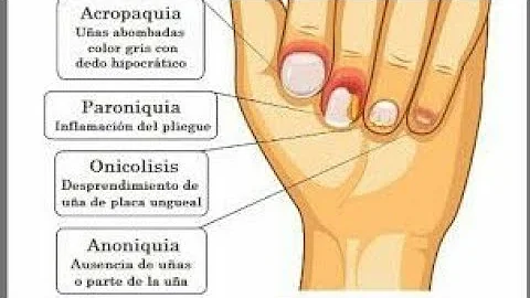 ¿Cuáles son los dos problemas más comunes de las uñas?