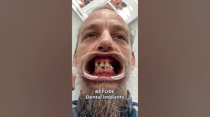 Before And After Smile Transformation! 🤯 Full Mouth Dental Implants! 🦷✨ #shorts - DayDayNews