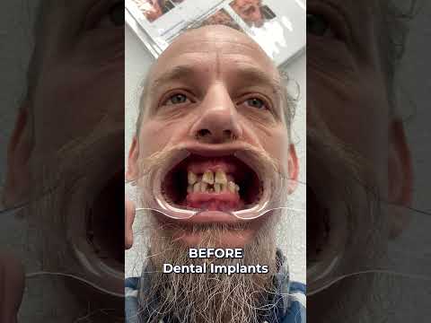 Reliable Dental Implant Options Centerburg OH