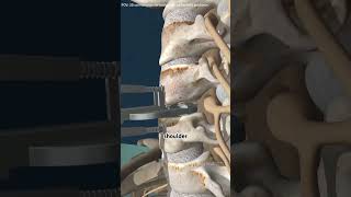 Cervical Disc Replacement Surgery (3D Animation) #rain #teethdecay #anatomy #doctor #bones #sad