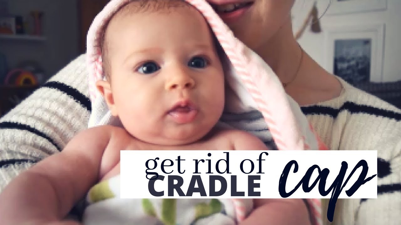 GETTING RID OF CRADLE CAP YouTube