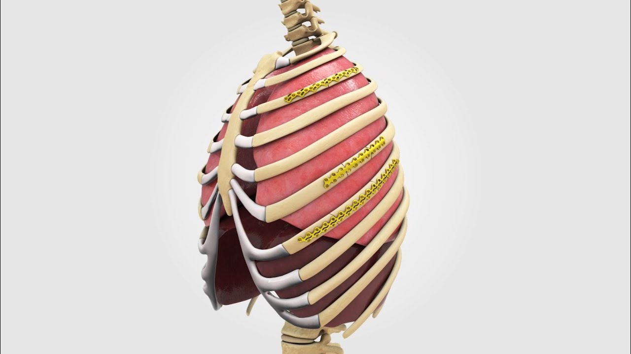 L1® Rib osteosynthesis system featuring CB3 technology - YouTube