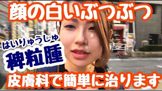 【前編】稗粒腫(はいりゅうしゅ)の治し方！あっと言う間に解決！顔にある白いぶつぶつに悩まされていませんか？【皮膚科】