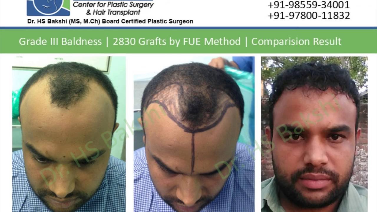 Hair Transplant in Jalandhar  Best Doctors Clinics  Cost  FCHTC