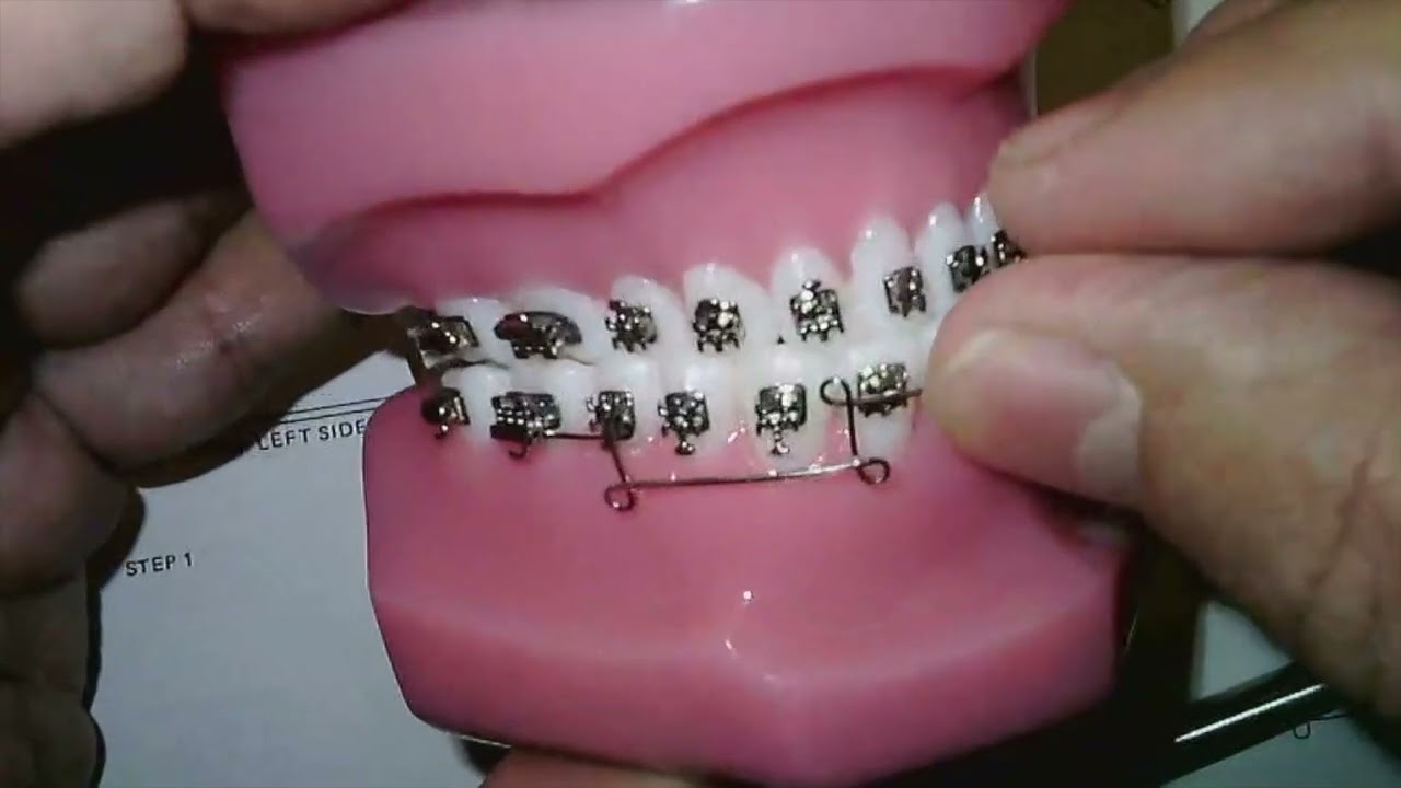 Ricketts lower retraction arch construction