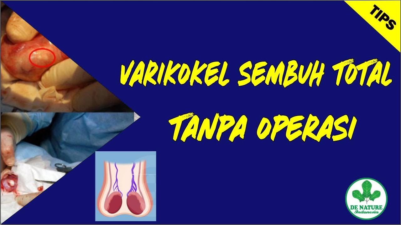 CARA ALAMI MENGATASI VARIKOKEL TANPA OPERASI