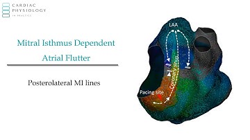 Mitral Annular (isthmus) flutter - sample from EP in Practice