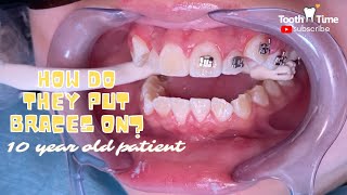 How do they put braces on? - 10 YEAR old patient - Tooth Time Family Dentistry New Braunfels Texas