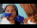 EDUCATIONAL TUTORIAL: LIP AUGMENTATION WITH FILLERS