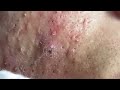 Relaxing blackheads removal pimple poppings blackheads removal large blackheads popping acne