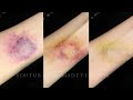 Bruise Makeup Tutorial | Special FX Series