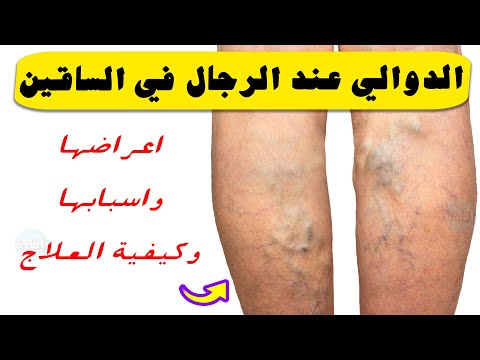 اعراض الدوالي عند الرجال