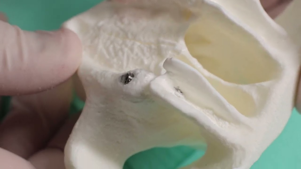 Educational video on the placement of pterygoid implants on an anatomical model