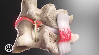 Spinal Ligament Angular Trauma on Nerve Health - Spinal Kinetics - 4K Animation
