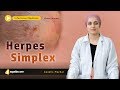 Herpes Simplex | Infectious Diseases Medicine Lecture | Medical V-Learning | sqadia.com