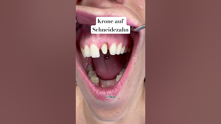 Schneidezahn kaputt? Krone wie der echte Zahn! #zahnkrone #krone #zahnersatz #zahnarzt