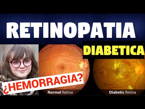 ¿QUÉ ES LA RETINOPATÍA DIABÉTICA?