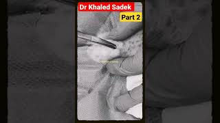 blackhead extraction #shorts #cystremoval #skincare Dr Khaled Sadek Lipomacyst.com