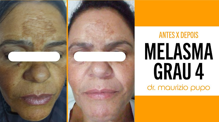 Melhor tratamento para melasma 2022