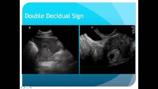 Introduction to 1st Trimester Pregnancy Ultrasound