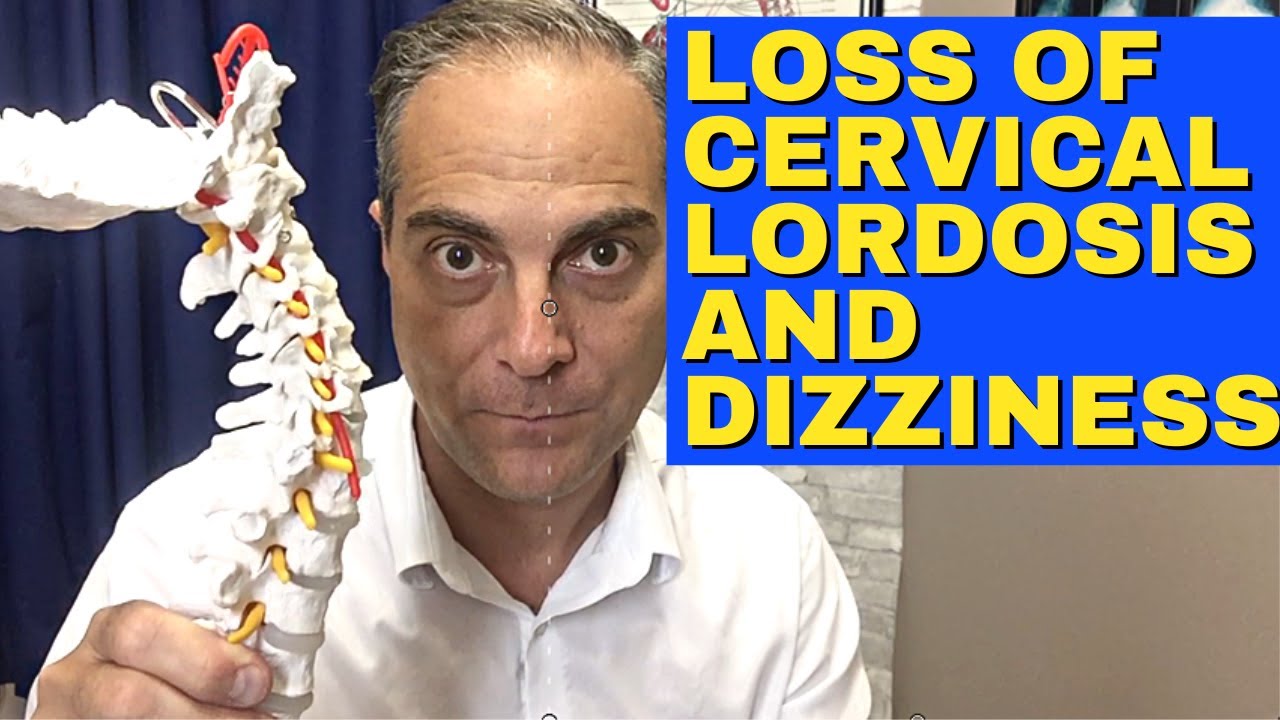 Ep24. Does Loss Of Lordosis Cause Dizziness And Vertigo? Dr. Walter Salubro Chiropractor in Vaughan
